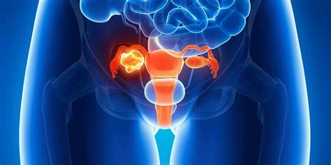 Ovarian Cancer Diagnosis: Why Early Detection Is So Difficult