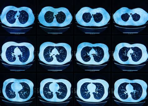 Mri Scan Of The Human Lungs Stock Photo - Download Image Now - iStock