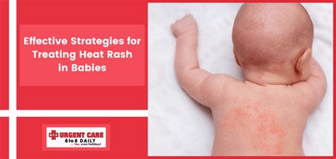 Effective Strategies for Treating Heat Rash in Babies | 8-2-8 Urgent Care