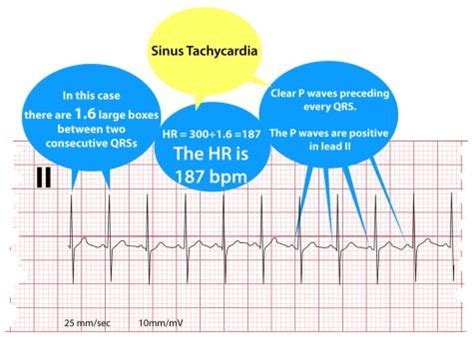 Electrocardiogram, sinus tachycardia. | Download Scientific Diagram