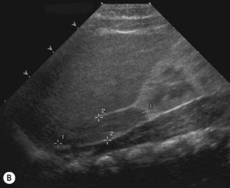 The adrenal glands | Radiology Key