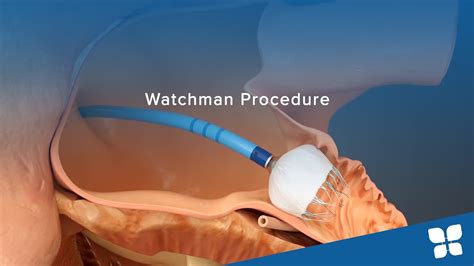 Watchman Procedure - YouTube