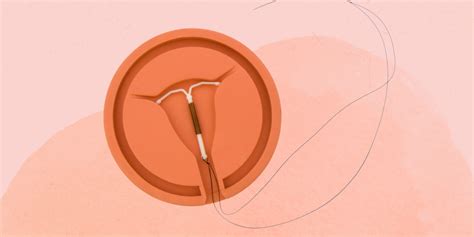 IUD Removal: How It Works and Side Effects to Expect | SELF