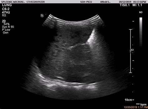 Cureus | Utilization of Point-of-Care Ultrasound to Detect Splenic Microabscesses in Pediatric ...