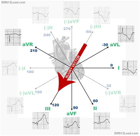 Image result for ecg leads | Cardiac nursing, Cardiology, Cardiac