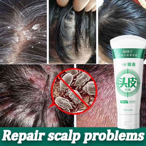 Anti Dandruff Scalp Treatment Hair Mites Shampoo Hair Loss Soothing Care Moisture Replenishment ...