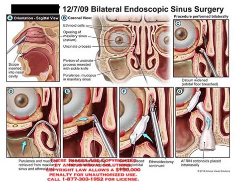 AMICUS Illustration of amicus,surgery,sinus,endoscopic,bilateral,scpoe ...