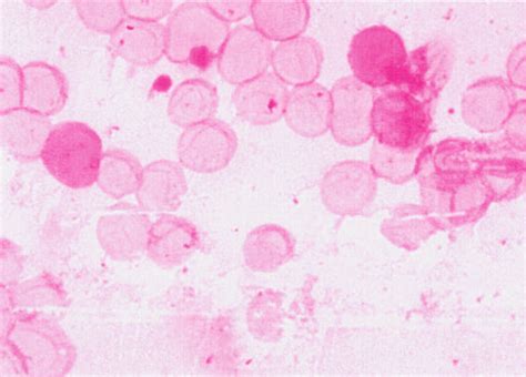 Kleihauer-Betke acid elution test. Blood smear from a postpartum... | Download Scientific Diagram