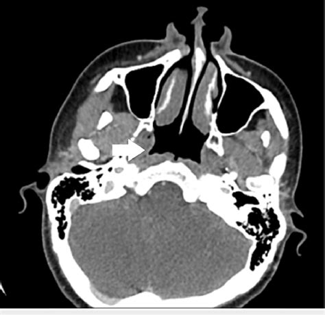 Axial CT image of the nasopharynx An axial CT image of the nasopharynx... | Download Scientific ...