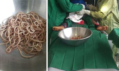 Surgeons pull dozens of 'writhing' parasitic WORMS from four-year-old boy's intestine | Daily ...