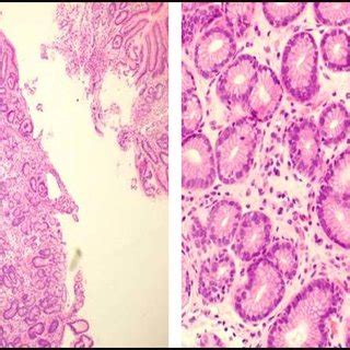 Gastric antrum biopsy: left: chronic inflammation. Right: chronic focal... | Download Scientific ...