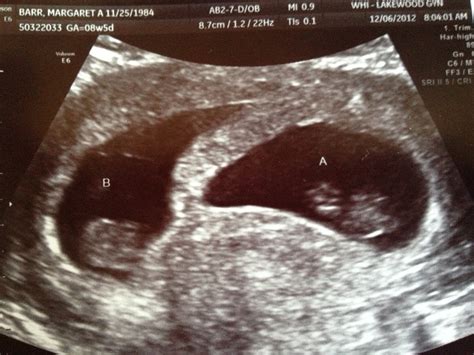 Why Does My Ultrasound Look Like Twins at Janet Haglund blog