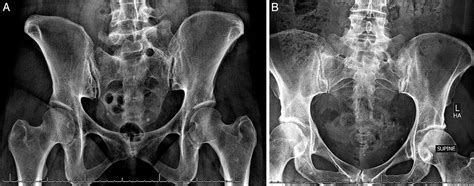 Sacral Dysmorphism and Lumbosacral Transitional Vertebrae (LSTV) Review ...