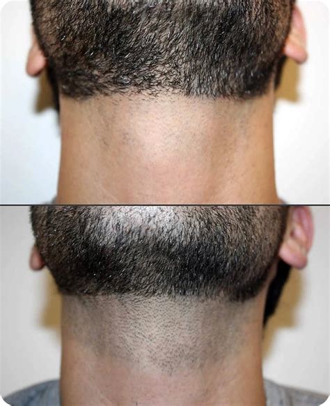 Electrolysis permanent body hair removal for men | Peach Clinics