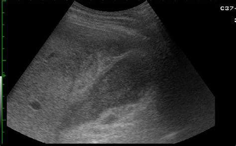 Ultrasound image during planning for cholecystostomy revealing ...