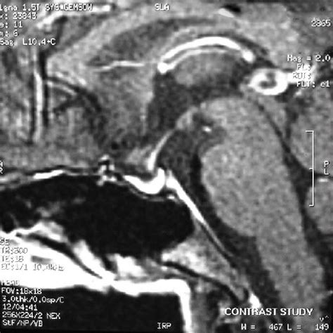 Magnetic resonance imaging showing partially empty sella | Download ...