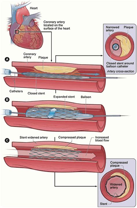 Restenosis, in-stent restenosis causes, symptoms, diagnosis, treatment & prognosis