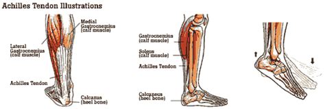 Achilles heel injury part 1