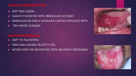 Erythroplakia