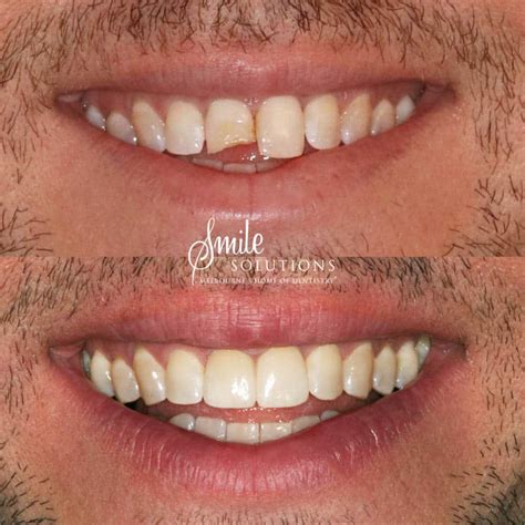 Porcelain Veneers Melbourne - Smile Solutions