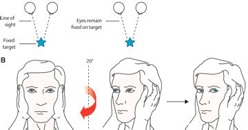 Northland Ear Nose and Throat: Head thrust test- an important test for vertigo.