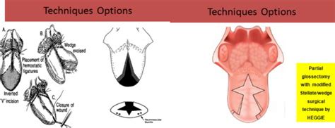 Partial glossectomy with Heggie technique. | Download Scientific Diagram