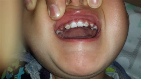 Enamel Hypoplasia | BabyCenter