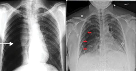 Chest X Ray With Pneumothorax