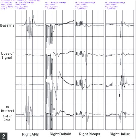 Motor-evoked potential signals monitoring showing loss of motorevoked... | Download Scientific ...