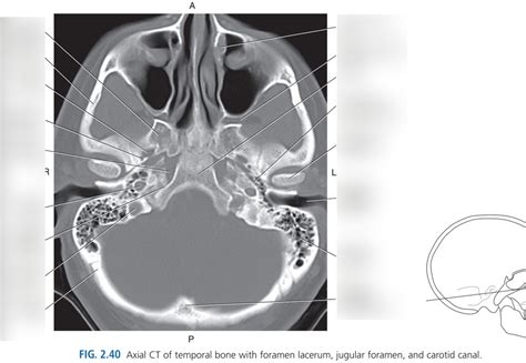 AXIAL CT TEMPORAL BONE FORAMEN LACERUM JUGULAR FORAMEN CAROTID CANAL ...