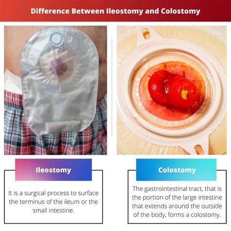 Ileostomy Vs Colostomy Colostomy Ileostomy Ostomy