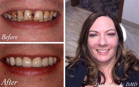 Before and After Photos of Dental Implants and Cosmetic Dentistry