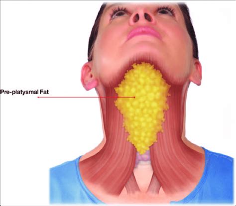 How to dissolve double chin fat without surgery - VCI