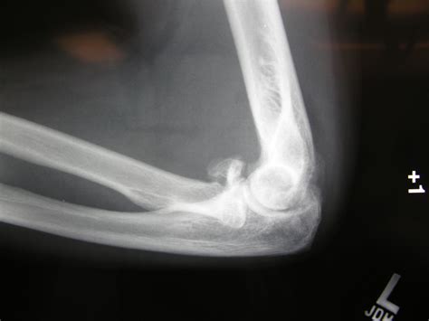 Radial Head Fractures-Hand Surgery-Wrist Surgery-Elbow Surgery