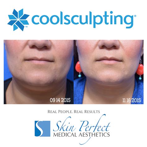 Coolsculpting | Under Chin | Double Chin Reduction