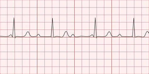 2nd Degree AV Block (Mobitz Type I) - Differential Diagnosis of