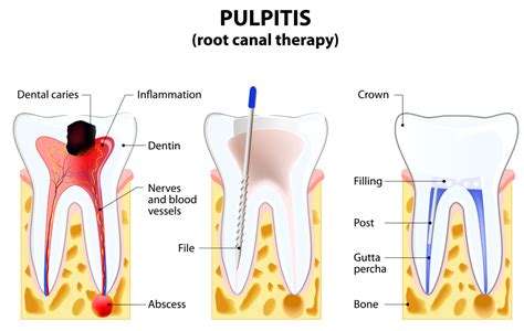 Root Canal - West Family Dentistry