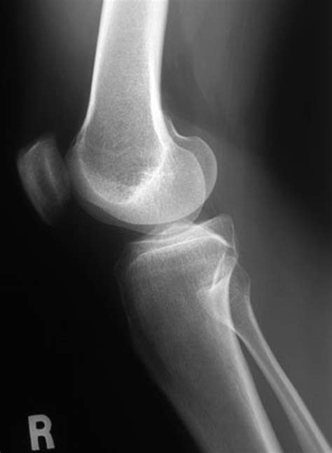 Three Different Types of Knee X-Rays With Photos | HealDove