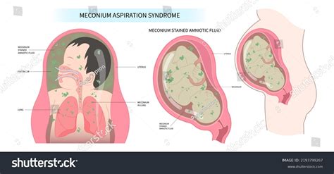 17 Baby Pulmonary Hypertension Images, Stock Photos & Vectors ...