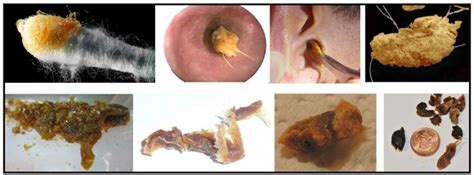 Earwax and Hearing Aids | Hearing Health & Technology Matters