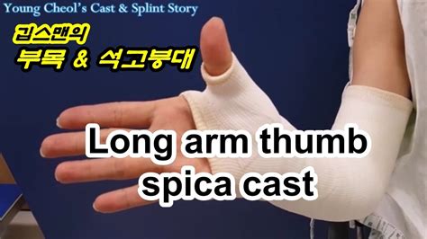 Long Arm Thumb Spica Cast - YouTube