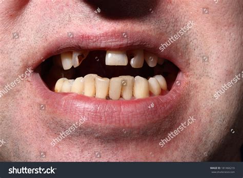 Bad Teeth Smoker Stock Photo 181466219 - Shutterstock