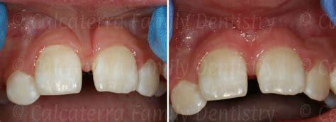 Laser Frenectomy and Tongue-Tie | Dentist Orange, Milford, West Haven