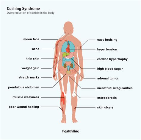 Cushing Syndrome: Signs, Causes, and Treatment