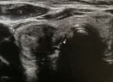 Ultrasound image of parathyroid adenoma. | Download Scientific Diagram