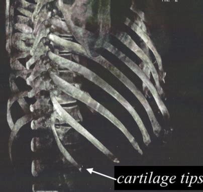 Cartilage tips of lower ribs Dr Barry Eppley Indianapolis - Explore ...