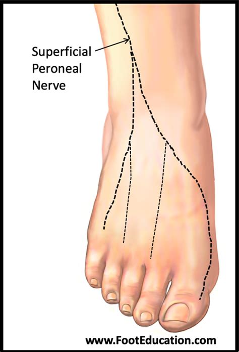 Superficial Peroneal Neuritis - FootEducation