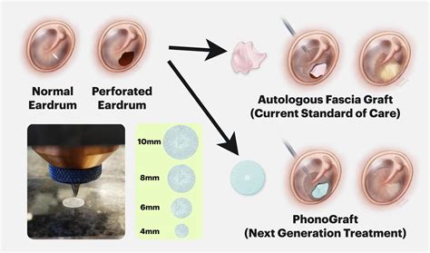 An Eardrum Patch | Medical Automation healthcare automation, equitable healthcare, medical ...