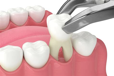 Tooth Removal Mansfield TX | Extraction | Mansfield Oral Surgery