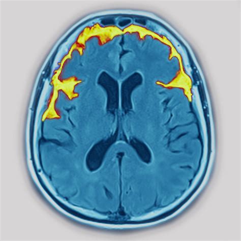 Understanding Frontotemporal Dementia, the Leading Cause of Dementia in People under Age 60 | 吃瓜大本营